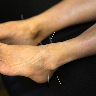 Acupuncture Image - 